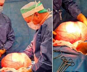 Lekarze usunęli 14-kilogramowego guza! Pacjentka żyje dzięki ich szybkiej reakcji