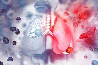 8 najczęstszych objawów raka płuc. To nie tylko kaszel 