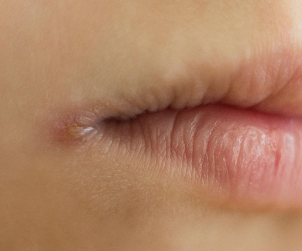 Zajady to coś więcej niż problem kosmetyczny. Jakie choroby mogą je wywołać?