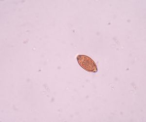 WŁOSOGŁÓWKA - objawy, leczenie zakażenia