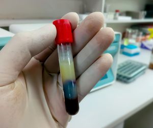 Cholesterol nie jest ważny, tylko trójglicerydy. Pytamy lekarza, skąd ten pomysł