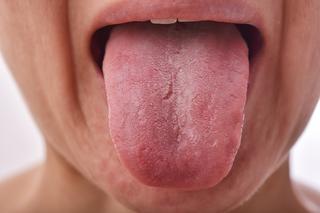 Pieczenie języka 