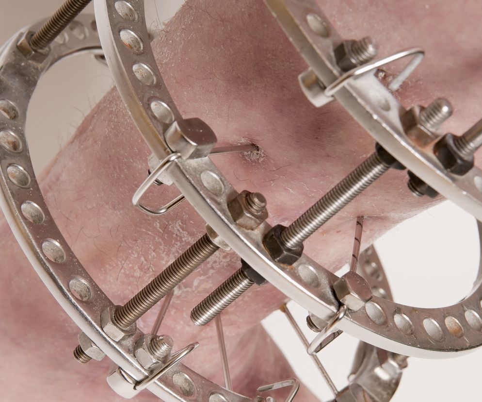 Metoda Ilizarowa znalazła zastosowanie w chirurgii rekonstrukcyjnej, ortopedii, a nawet w chirurgii plastycznej.