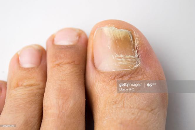 Grzybica paznokci - paznokcie u stóp