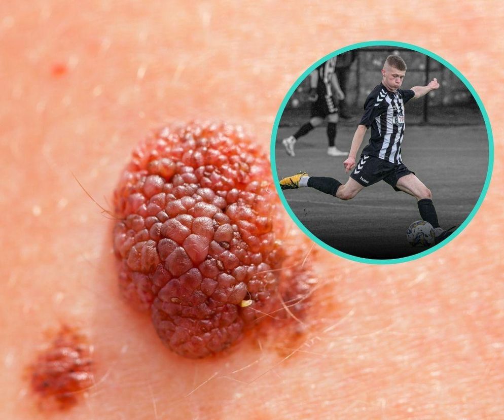 Nie żyje 20-letni piłkarz. Nie przypuszczaliśmy, że zwykły pieprzyk może być tak groźny