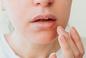 Zmiany na ustach - krostki, grudki, pęcherzyki. 8 najczęstszych przyczyn [ZDJĘCIA]