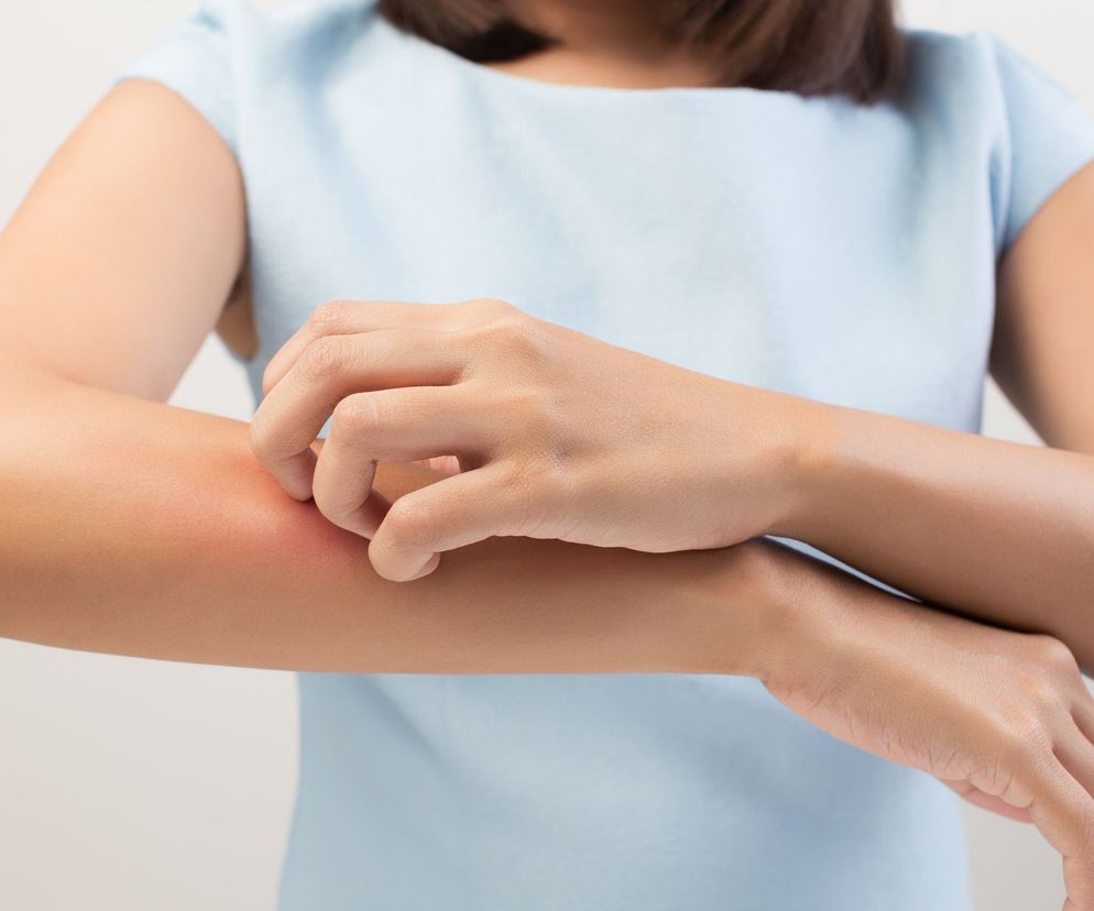 Ziarniniak grzybiasty (chłoniak pierwotny skóry, MF, łac.  mycosis fungoides ) jest, jednym z najczęściej występujących chłoniaków skóry  o przewlekłym przebiegu.