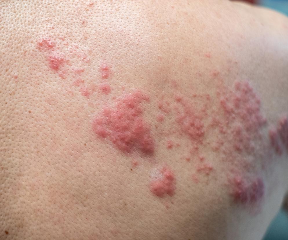 Szczepionka Shingrix już dostępna w Polsce. Kto powinien ją przyjąć? 