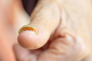 Zaawansowana grzybica paznokci u dłoni