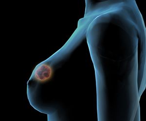 Rak piersi w wyniku rozrostu komórek przewodu mlecznego