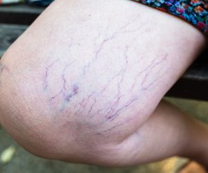 Masz na nogach pajączki? Ten zabieg pomoże ci się ich pozbyć