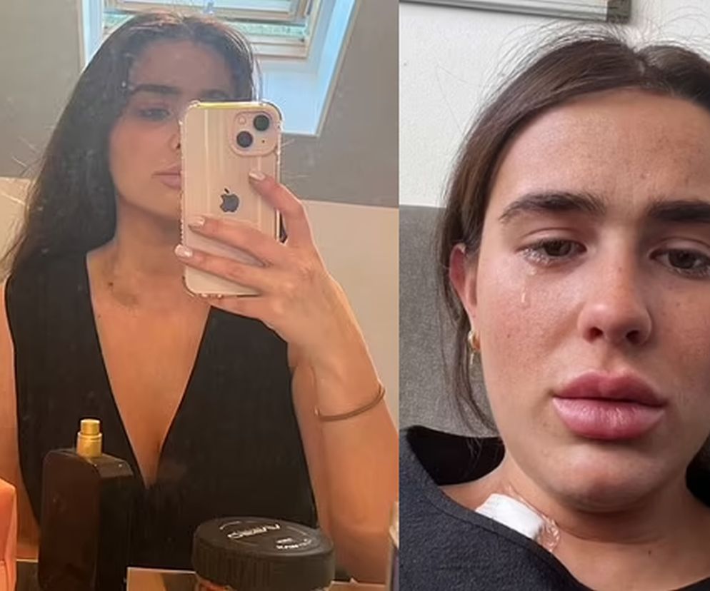 Lekarz twierdził, że to objaw przeziębienia. Mały guzek na szyi 28-latki okazał się rzadkim nowotworem