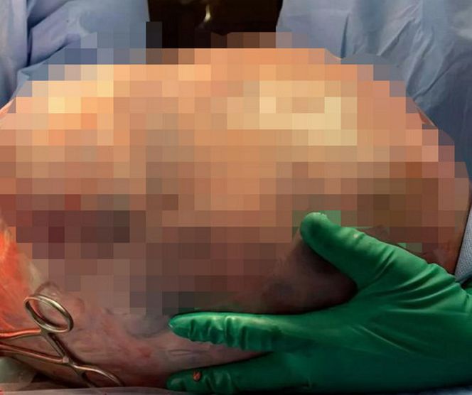 Ogromny guz jajnika usunięty w Centrum Onkologii w Bydgoszczy