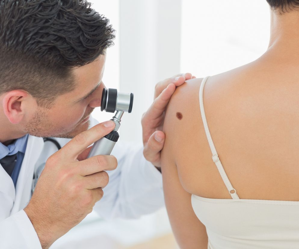 Dermatolog w celu dokładnego obejrzenia znamion posługuje się dermatoskopem.