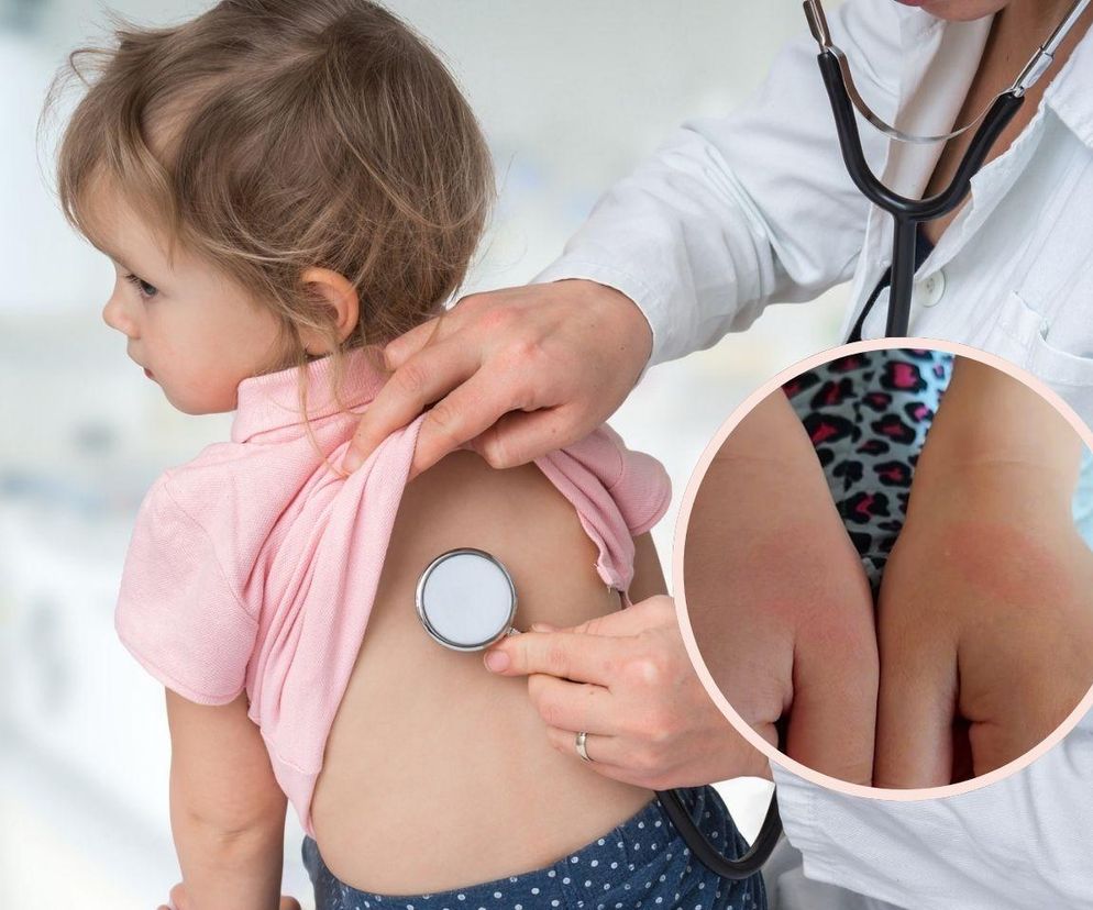 To ukąszenie czy rumień po boreliozie? Pediatra wyjaśnia