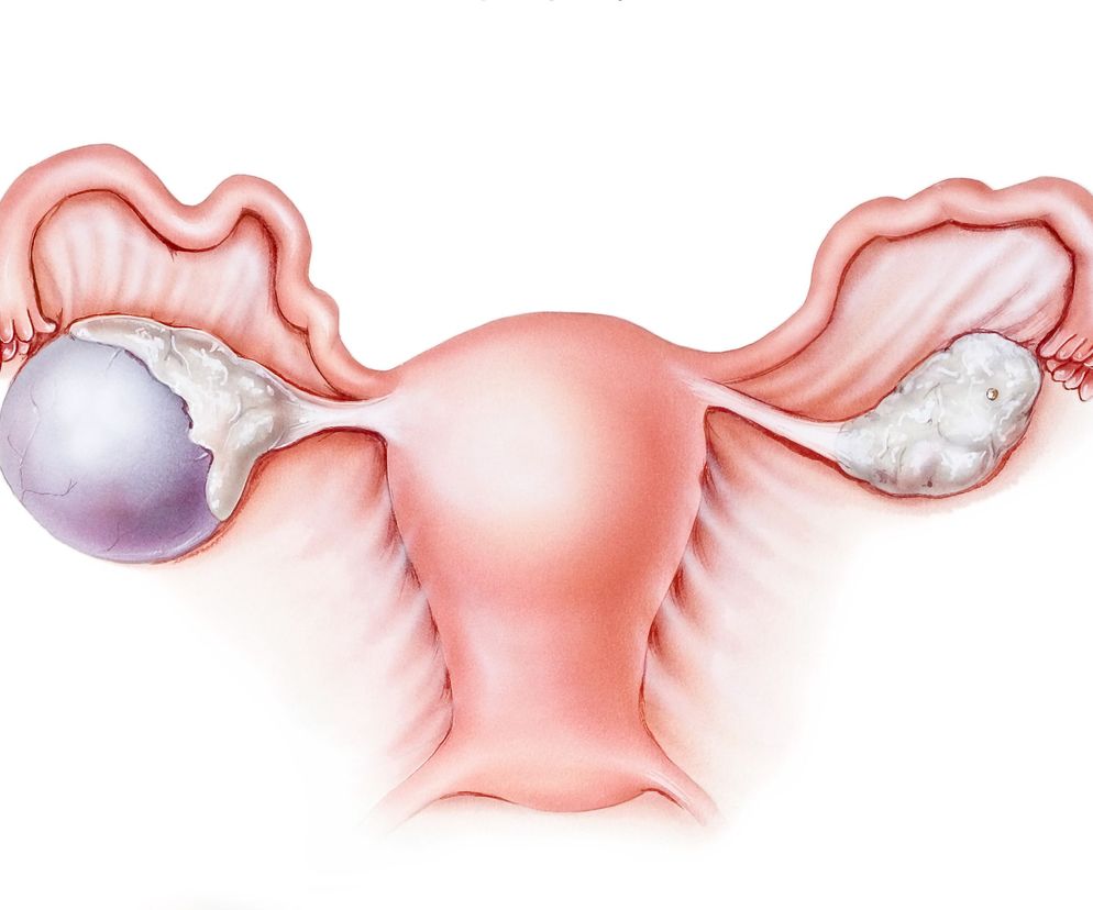 Torbiel czekoladowa to otorbiona struktura pojawiająca się w obrębie jajnika w przebiegu częstej patologii – endometriozy.