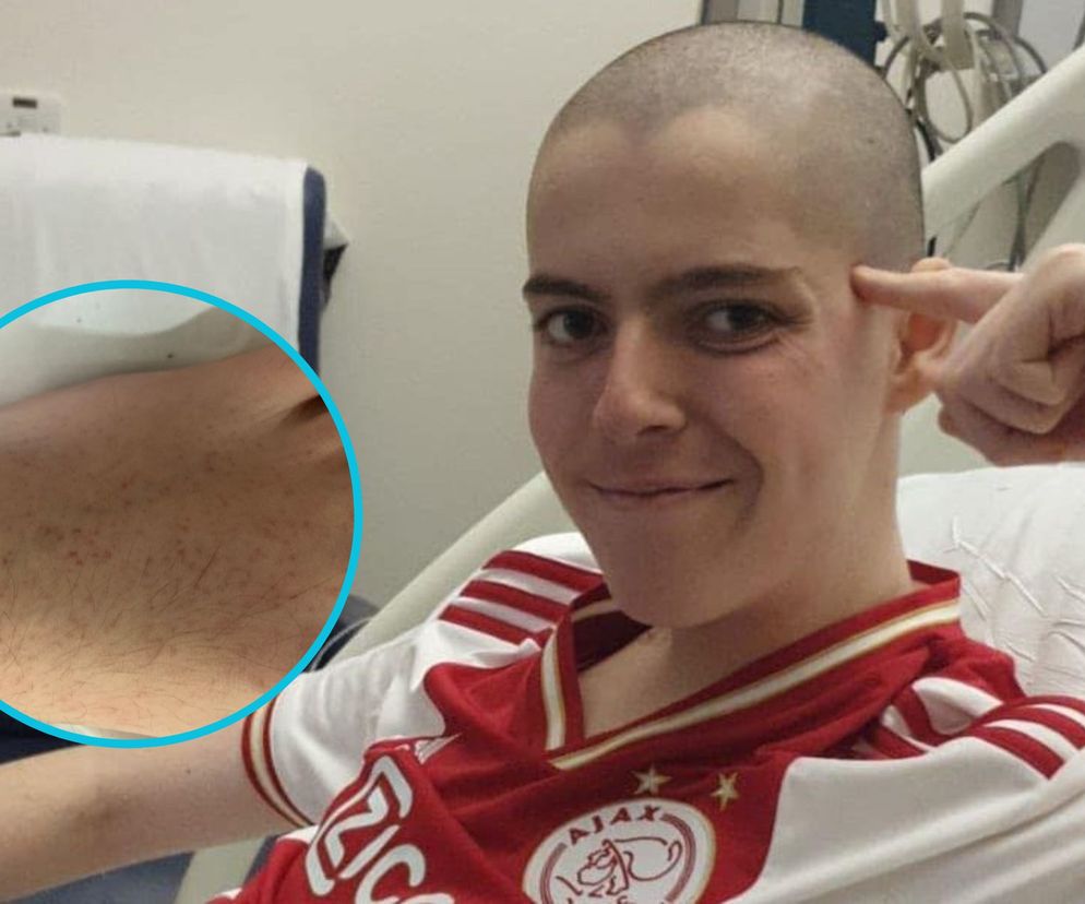 Lekarz zignorował wysypkę u 16-latka. Tak dawał o sobie znać nowotwór