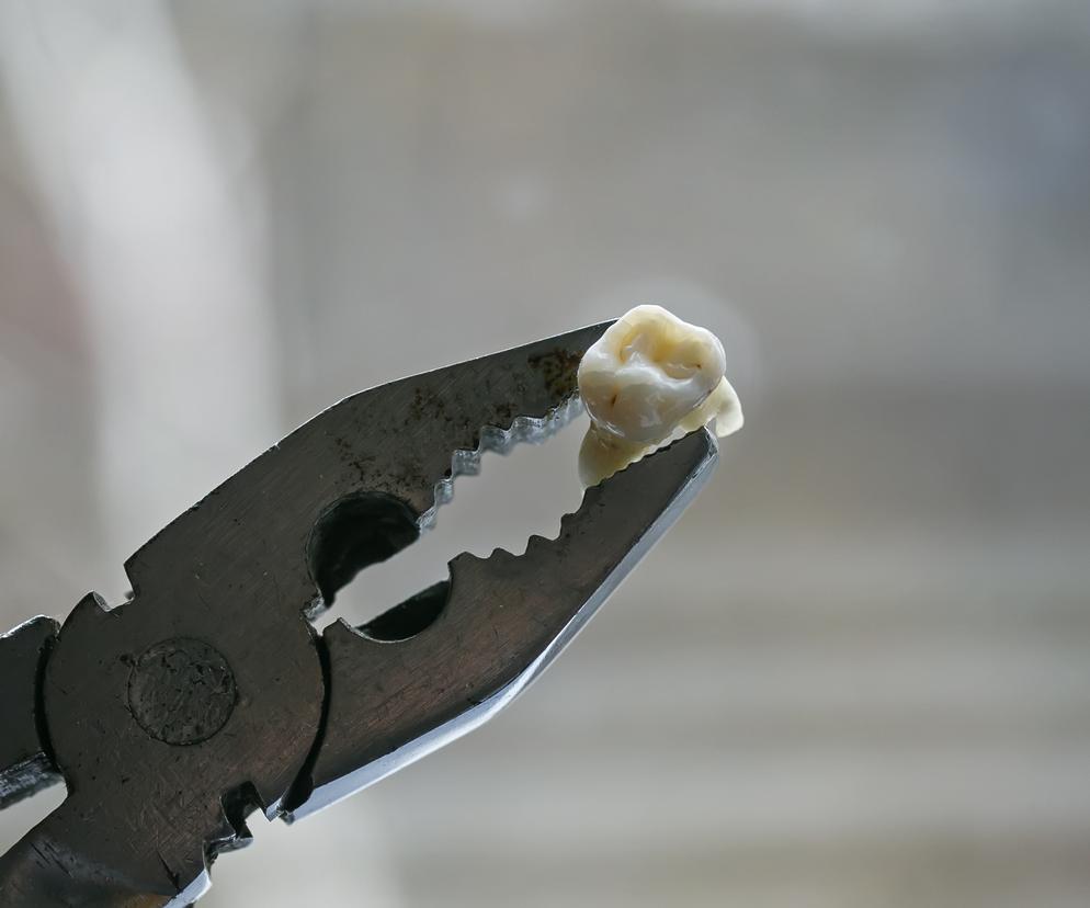 Mężczyzna kilka razy wyrwał sobie zęby, bo nie mógł się dostać do lekarza