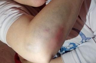 Potrącenie pieszej na pasach na rondzie santockim w Gorzowie. Poszkodowana pokazała poobijane ciało