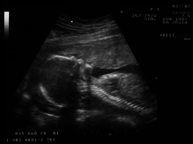 USG dziecka w 20 tygodniu ciąży
