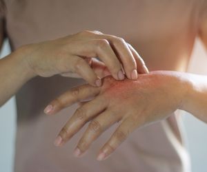 Alergia krzyżowa - objawy. Tabela alergenów krzyżowych