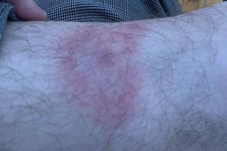 Rumień wędrujący to jeden z pierwszych i najbardziej rozpoznawalnych objawów boreliozy