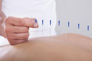 Akupunktura: czy i na co działa?