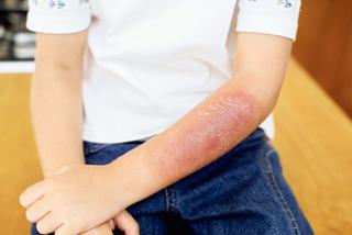 Oparzenia  u dzieci: rodzaje i stopnie oparzeń, leczenie oparzeń