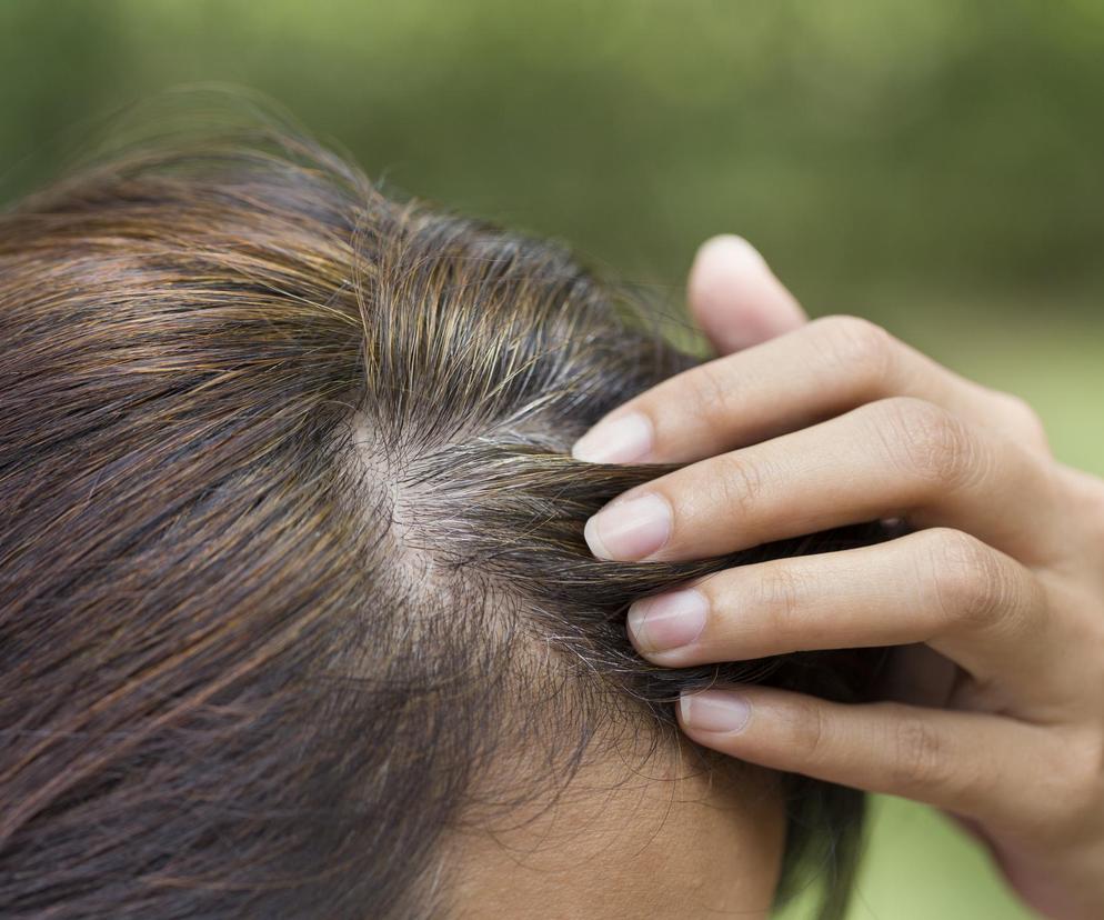 Nie musisz osiwieć raz na zawsze. Przedwczesne siwienie można już cofnąć