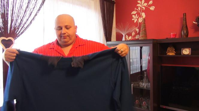 Zmniejszyli żołądek bez otwierania brzucha