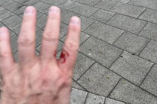 Kobieta pobita przez staruszka, bo zwróciła mu uwagę. Przewrócił mnie na chodnik i okładał parasolką, potem uderzył pięścią w twarz