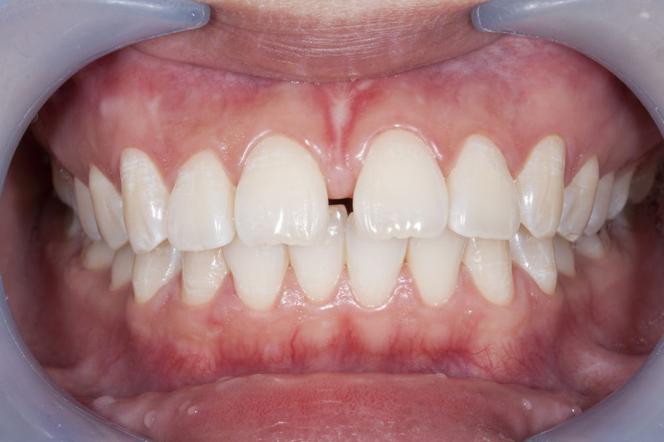Diastema, czyli przerwa między zębami - jak ją usunąć? Likwidacja diastemy