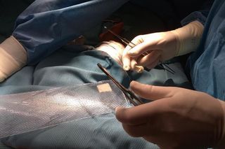 Poparzona dziewczynka na stole operacyjnym