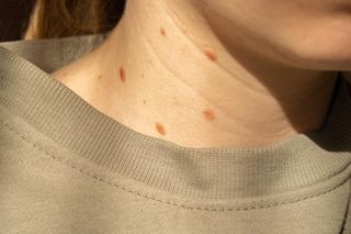 Wyglądają jak drobny defekt, a mogą zdradzać problemy z insuliną. Wysyp włókniaków to ważny sygnał od organizmu