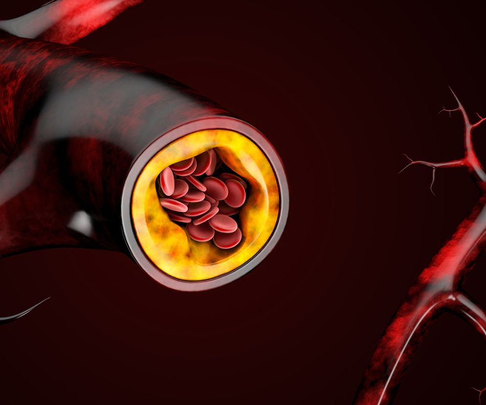 Cholesterol LDL