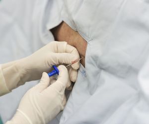 Znieczulenie porodu: znieczulenie podpajęczynówkowe przy cesarskim cięciu