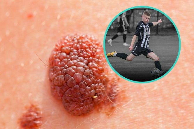Nie żyje 20-letni piłkarz. Nie przypuszczaliśmy, że zwykły pieprzyk może być tak groźny