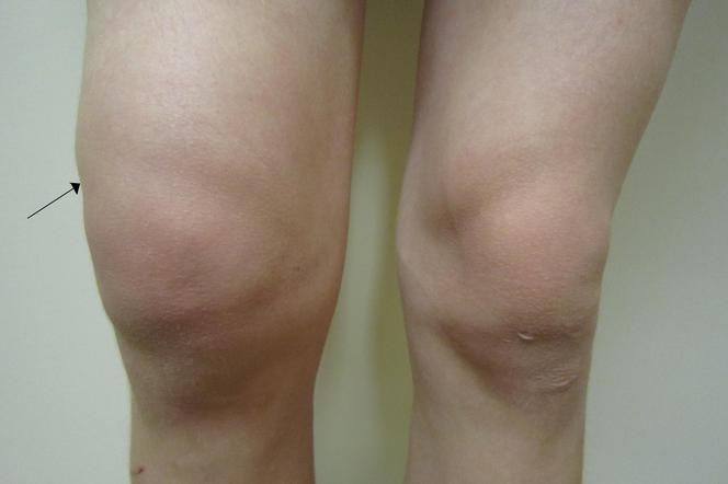 Woda w kolanie- jak rozpoznać objawy wysięku w stawie kolanowym?