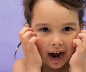 To nie tylko pierwsza pomoc przy ospie. Gencjana - poznaj jej właściwości i zastosowanie