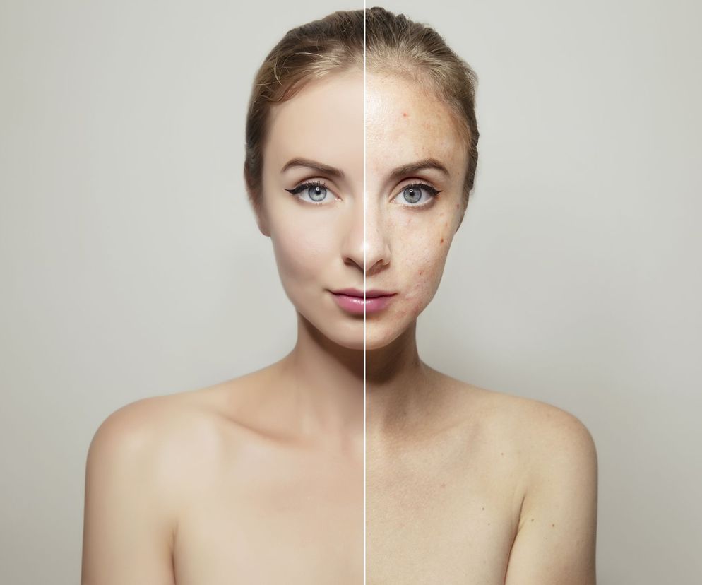 Najwięcej gruczołów łojowych znajduje się na twarzy, owłosionej skórze głowy i górnych częściach tułowia.