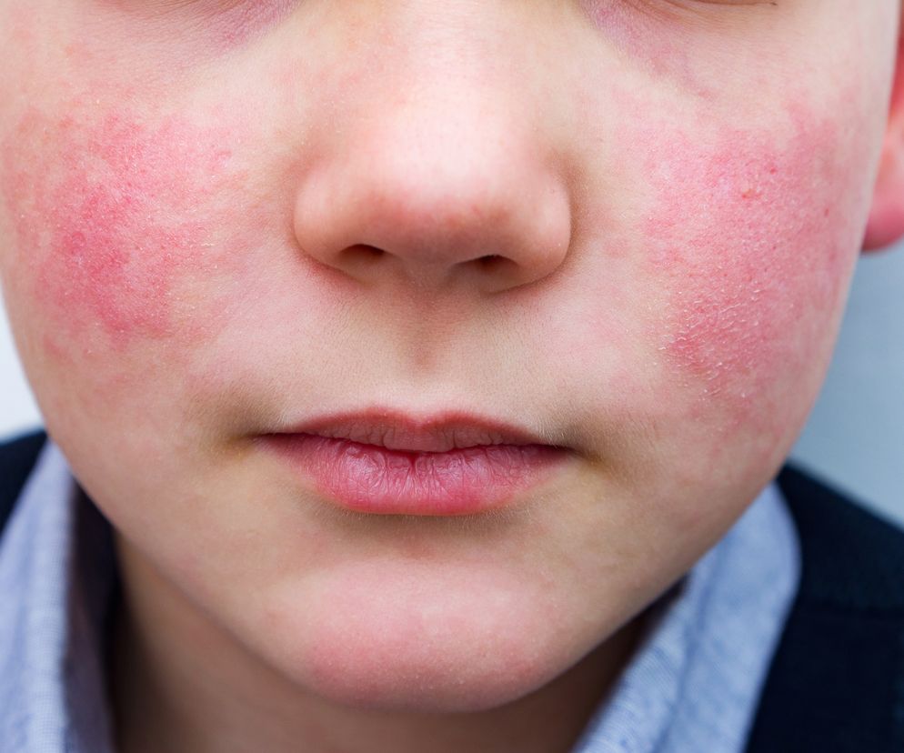 zbliżenie na twarz chłopca chorego na rumień zakaźny