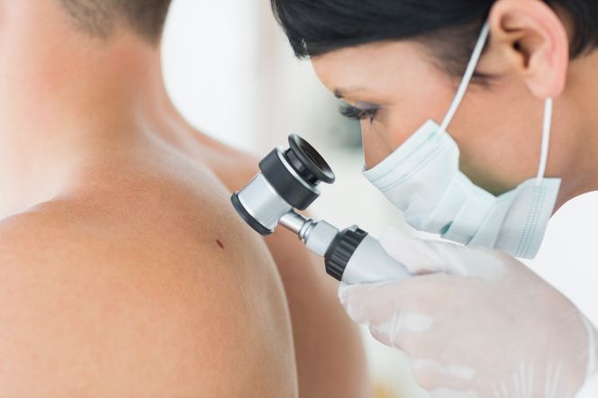 Dermatoskopia - badanie znamion dermatoskopem