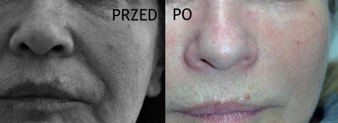 Nie martw się zmarszczkami! Zobacz, jak alser Perfectus 3D odmłodził te kobiety
