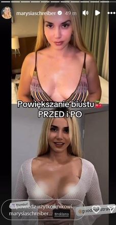 Marianna Schreiber po operacji biustu w Turcji. Mówi o konsekwencjach zabiegu
