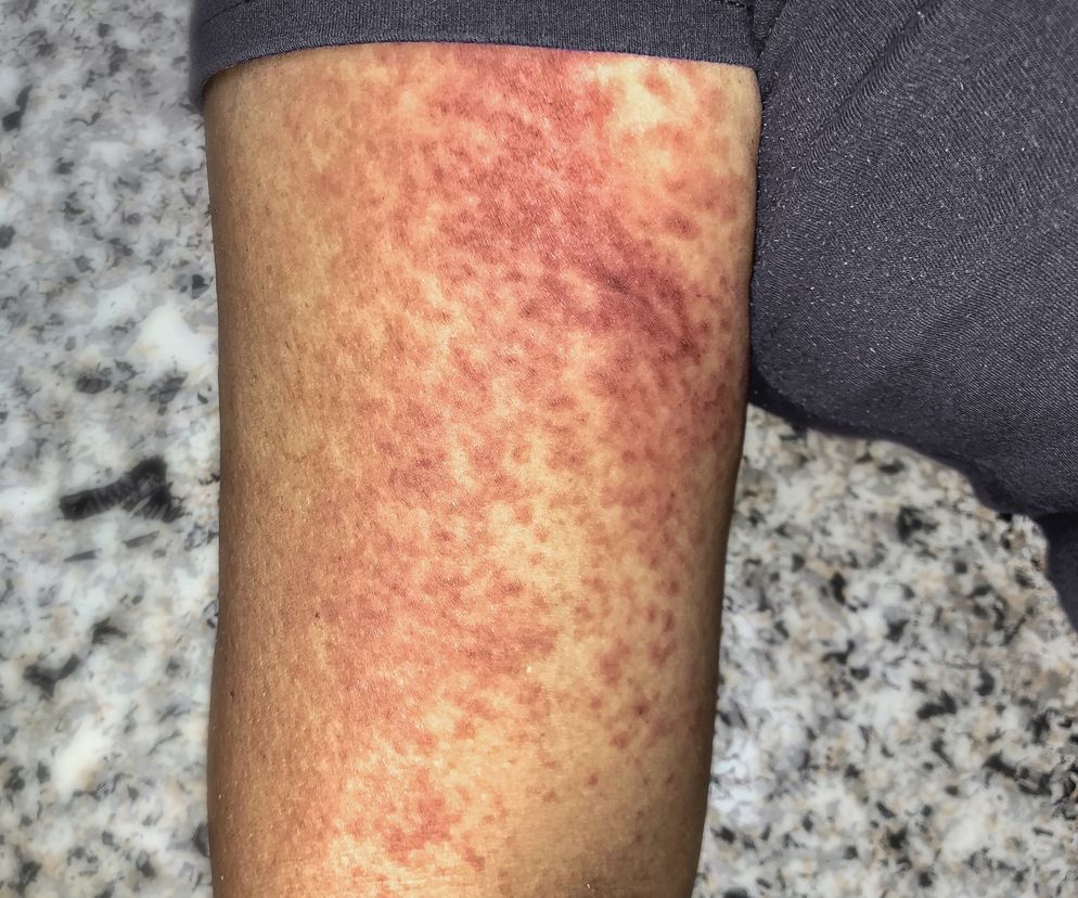 Umiera nawet 50 proc. zarażonych. Krymsko-kongijska gorączka krwotoczna dotarła do Europy