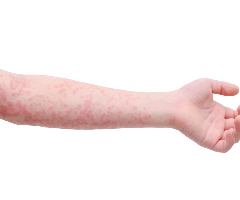 Zespół Stevensa-Johnsona rozwija się najczęściej po zażyciu niektórych leków