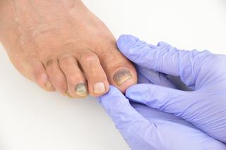 Zasinienie pod paznokciami też może być objawem grzybicy paznokci