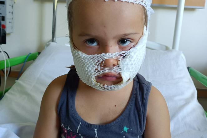 Amstaff rozszarpał buzię 4-letniej Nadii