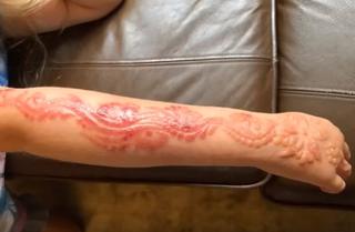 poparzenia tatuażem