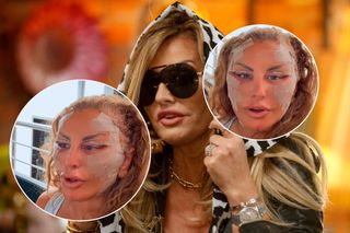 Kaźmierska z pozalepianą twarzą. Pokazała się dzień po operacji plastycznej! Nie da się jej rozpoznać